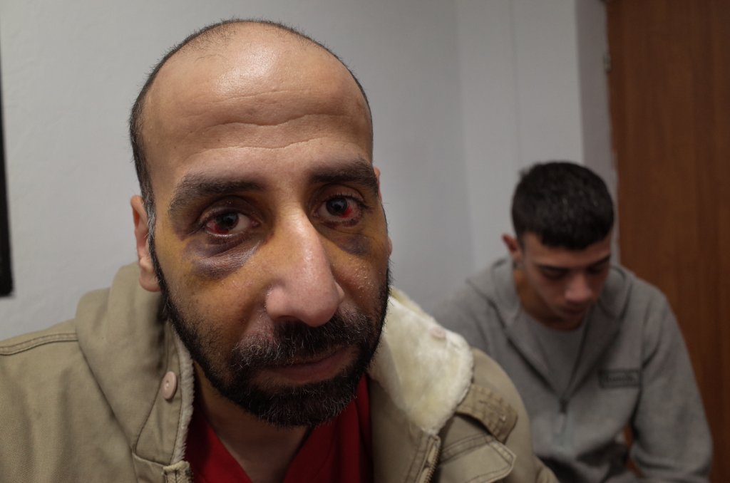 Deux semaines après son agression, Youssef a encore le visage marqué par des hématomes. Crédit : Mehdi Chebil pour InfoMigrants