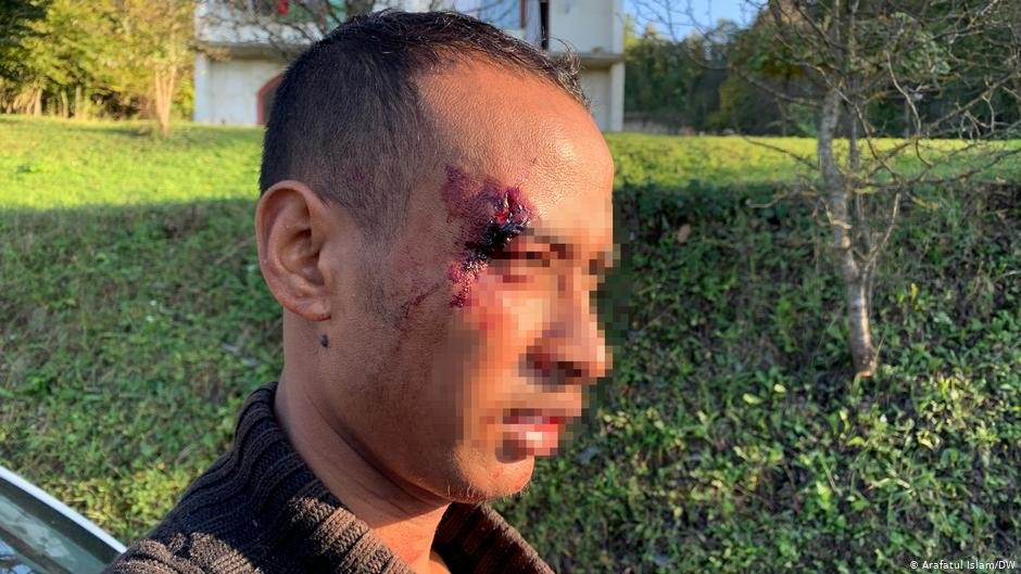 File photo: This man told InfoMigrants in 2020 that he had been beaten by Croatian police | Photo: Arafatul Islam/DW