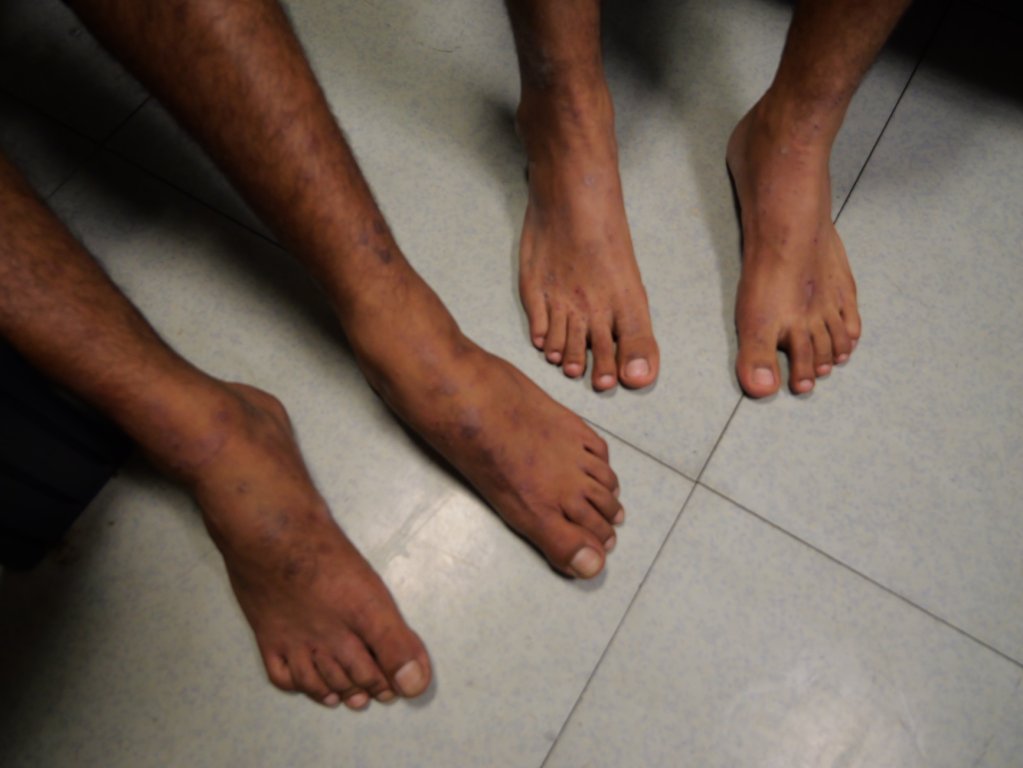 Salman and Mohammed show the marks and scars from the beatings they endured in Libyan detention, as well as the effects of the poor living conditions | Geo Barents, Central Mediterranean, February, 2024 | Photo: Sou-Jie van Brunnersum