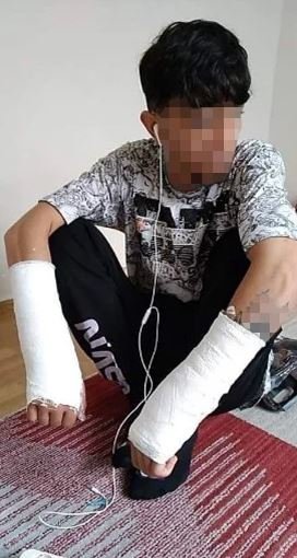 یک پناهجوی ۲۱ ساله افغان در ماه نوامبر۲۰۲۱ پس از عبور از ترکیه به مرز بلغاریا توسط پلیس به شدت زخمی شد. عکس:HRW 