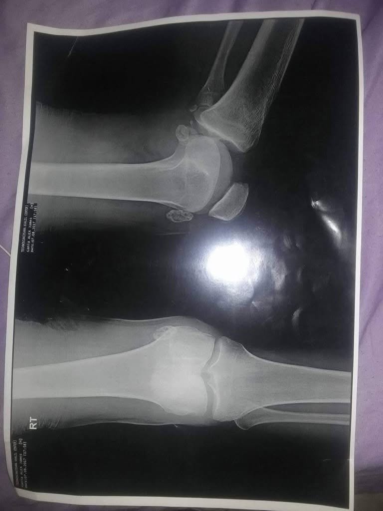 A photo taken by Alex James Ganya of an X-ray of his injury while he was in Egypt in 2013 | Source: Photo provided by Alex James Ganya