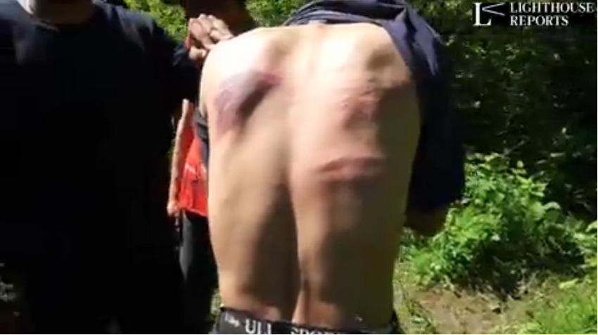 A video of the bruising made by the baton known as Tonfa has been posted on Lighthouse Reports Twitter feed | Source: Twitter @LHreports