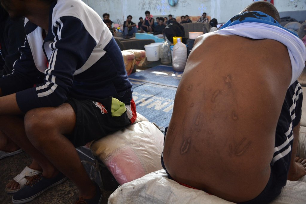 أحد المهاجرين يبين آثار التعذيب التي تعرض لها في ليبيا