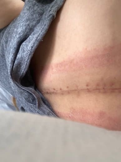 Scars from Hila's operation | Photo: Private