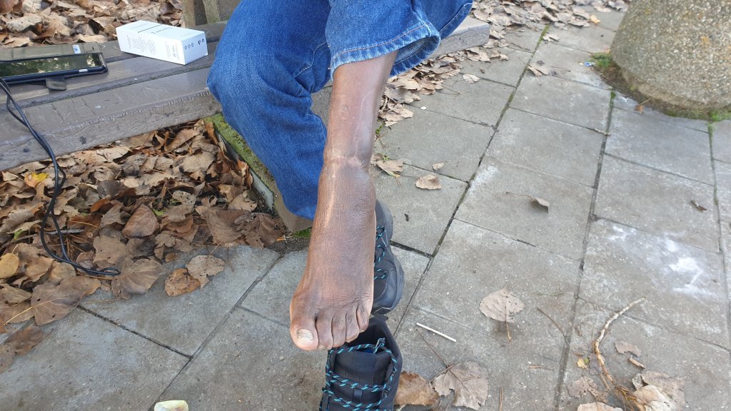Anthony montre la cicatrice qui court le long de sa jambe. Crédit : Majda Bouazza