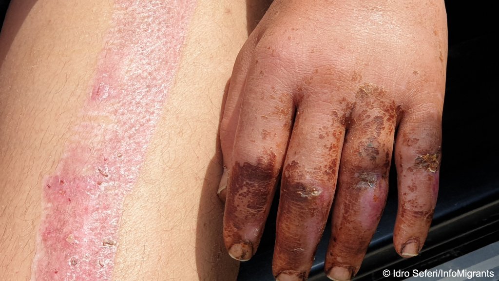 La main de Jalal est gonflée et unie cicatrice court sur toute sa jambe, plus de trois semaines après l’accident. Crédit : Idro Seferi / InfoMigrants