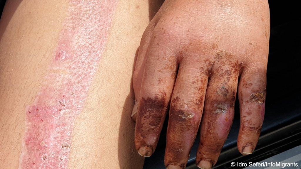 يد جلال منتفخة وجلد ساقه متورمًا بعد مرور أكثر من ثلاثة أسابيع على الحادث 