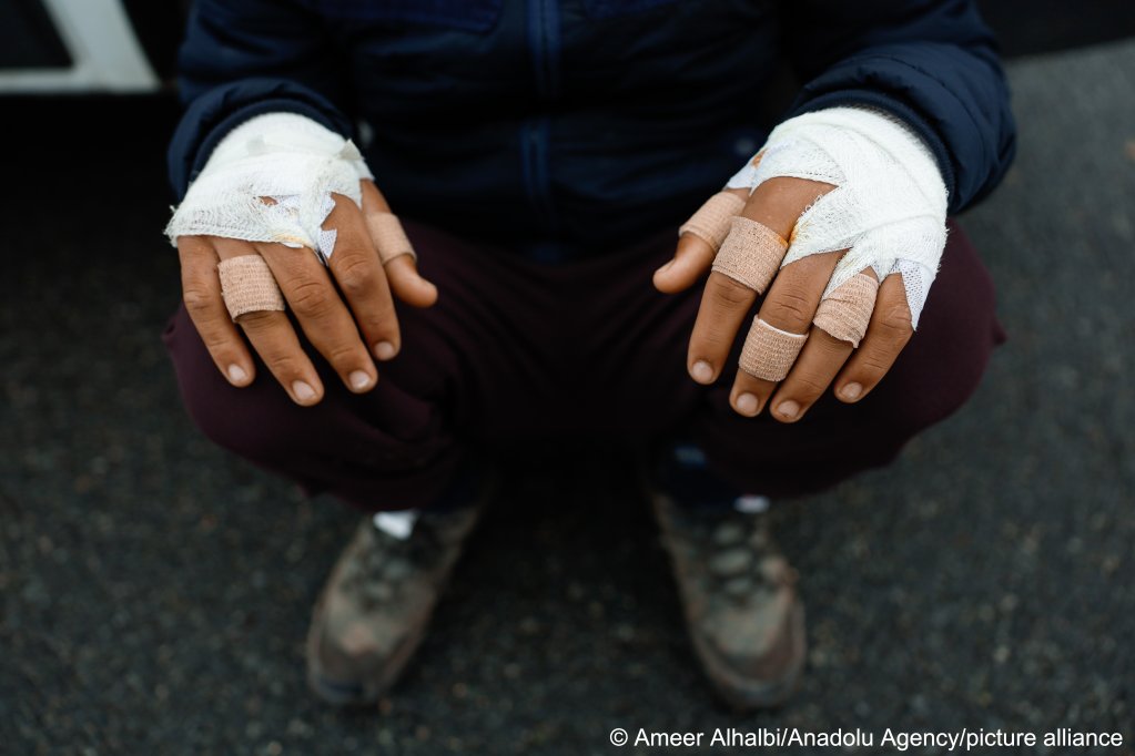 Migrants are increasingly willing to put up with harsh conditions during winter months in migrants camps across northern France, waiting for the right moment to attempt irregular Channel crossings - even with frost bites | Photo: picture-alliance / AA / Ameer Alhalbi