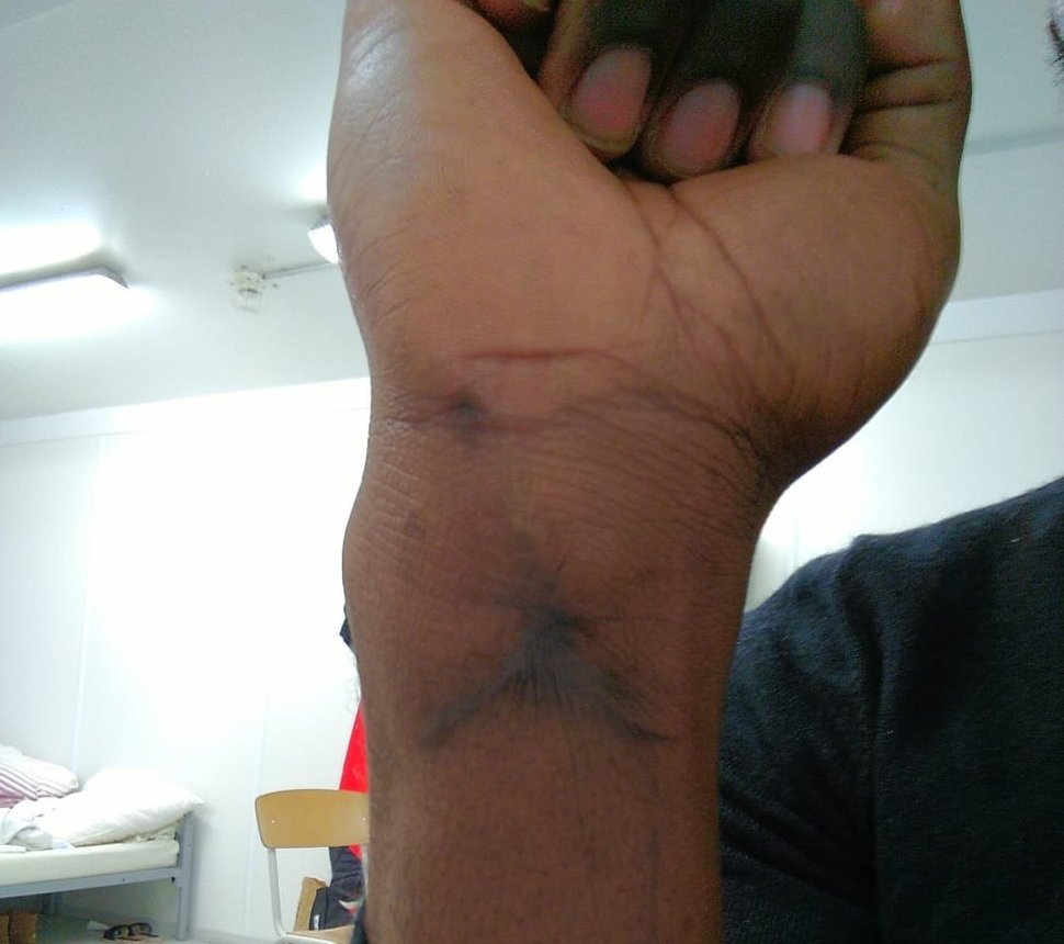 Jean* montre sa cicatrice au poignet. Il s'est blessé en s'évadant de la prison en Libye. Crédit : DR