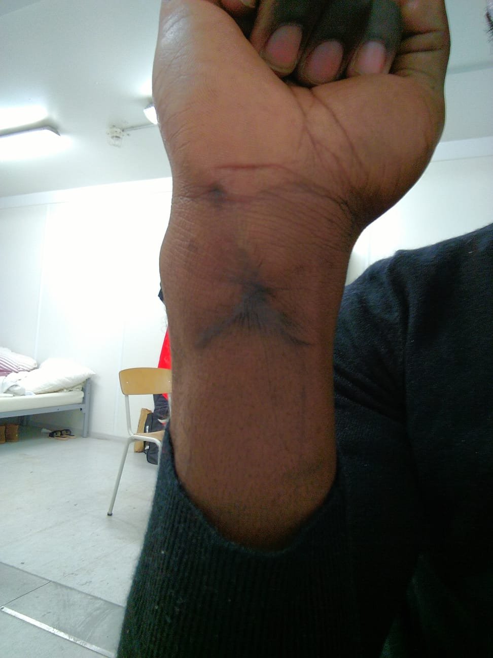 صورة للندبة التي خلفها الجرح الذي أصيب به تييري عند محاولته الهرب من سجن ميليشيا قامت باختطافه. الصورة: مهاجر نيوز/ من هاتف المهاجر تييري