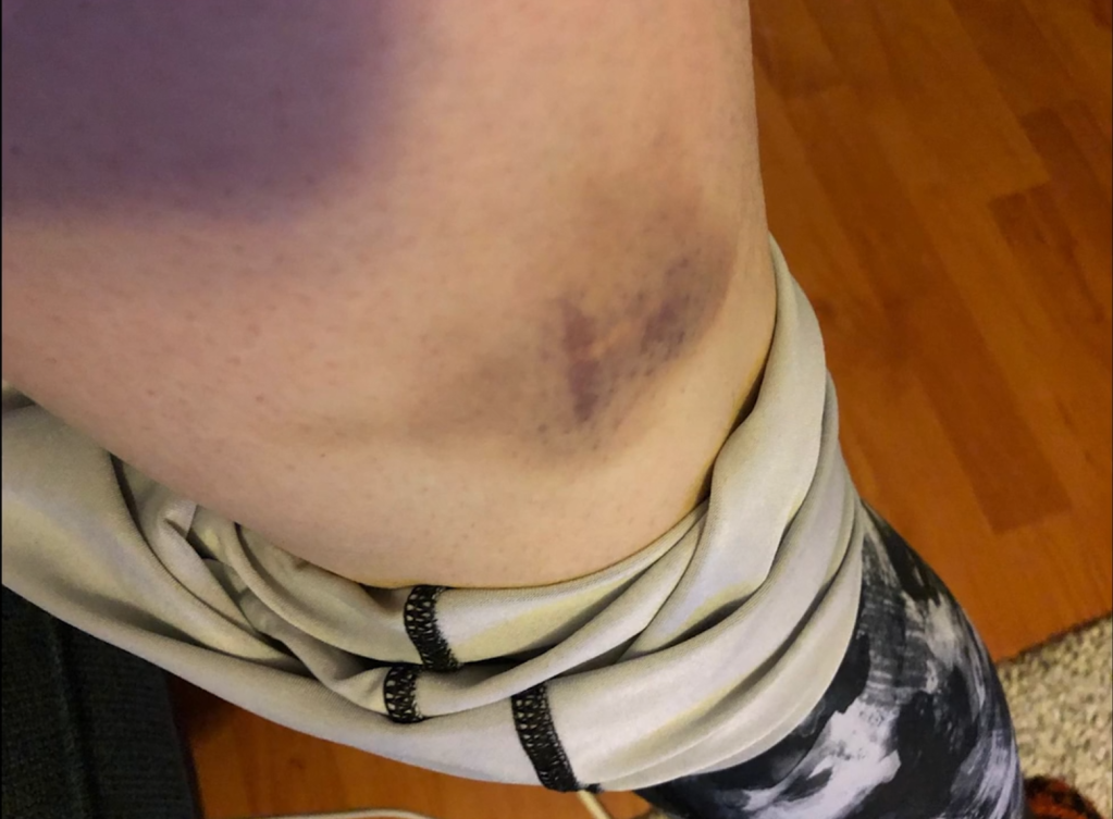 Parvin took pictures of her bruises she claims were a result of being detained by Greek border guards in 2020 | Source: Screenshot Forensic Architecture video @ForensicArchi