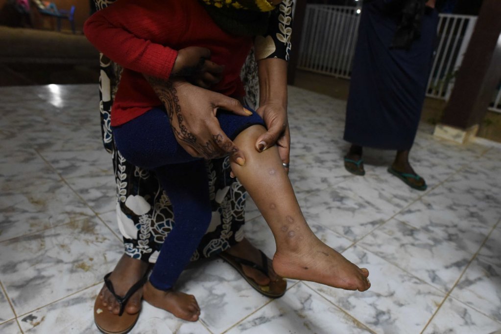 طفلة تعرضت للتعذيب على يد ليبيين اختطفوها وتظهر الندوب على ساقيها.