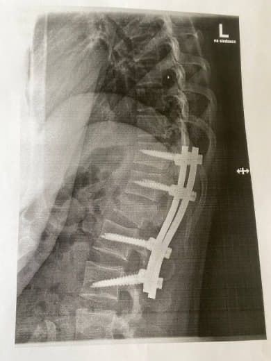 An X-ray of Hila's back shows how many pins had to be inserted | Photo: Private