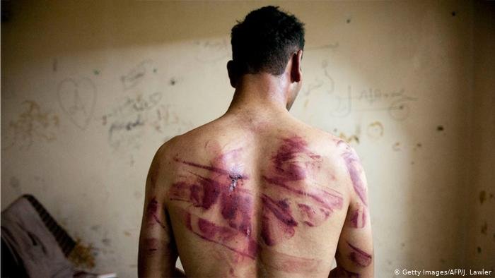 صورة من الأرشيف للآثار تعذيب تعرض لها سوري على يد قوات الأمن
