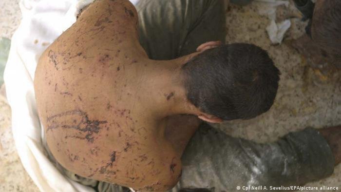 التعذيب كما في الصورة من حالة في العراق، مدان ومحرم عالميا، ومع ذلك هو شائع الاستخدام في كثير من الدول