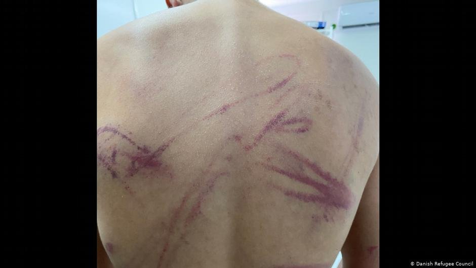 Photo of a migrant who claims he was abused by Croatian police | Photo: Danish Refugee Council