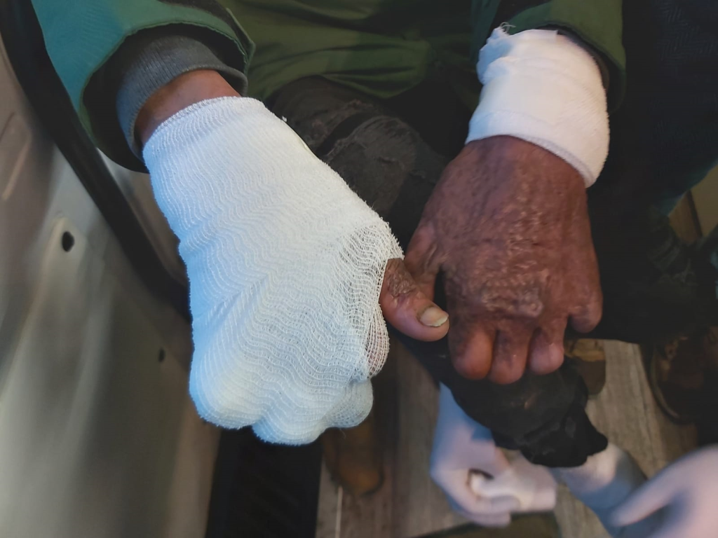 Burnt hands belonging to a migrant in Bosnia | Photo: Gerhard Trabert