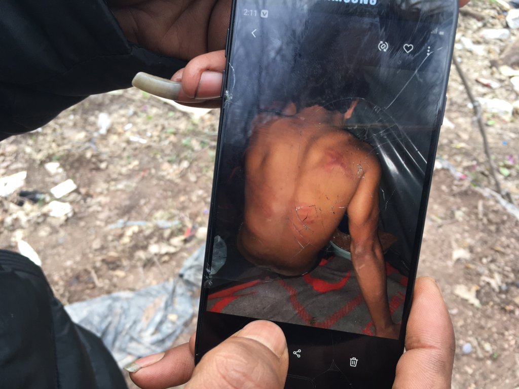 Abdul Rahmane, 17 ans, a été battu par la police croate avait avoir franchi la frontière depuis la Bosnie. Crédit : InfoMigrants.
