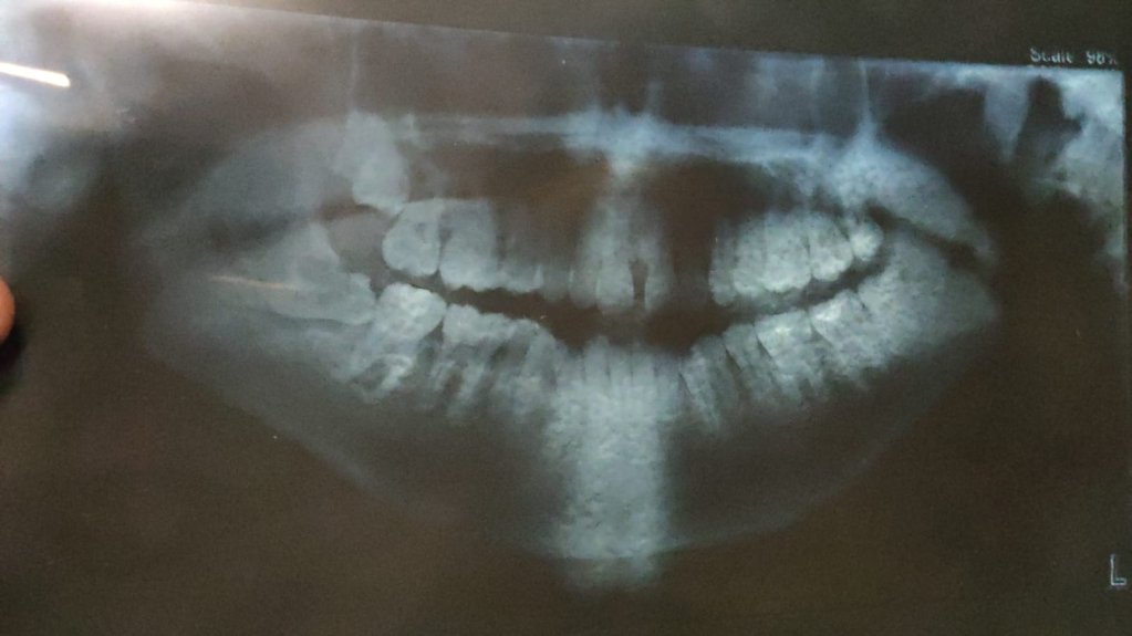 An image of Ayoub's jaw and teeth after being hit with a gas cannister | Photo: Private