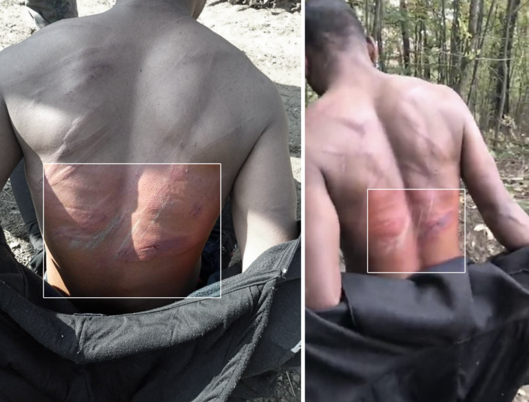 Still from a video taken in the aftermath of an alleged pushback by a Bosnian man on October 19, 2020 documenting a group of men displaying severe bruising on their backs | Credit: Border Violence Monitoring Network