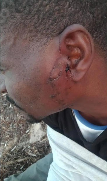 A man who told HRW he was expelled to the Libyan border on July 2 shows his injuries | Photo: Private / HRW