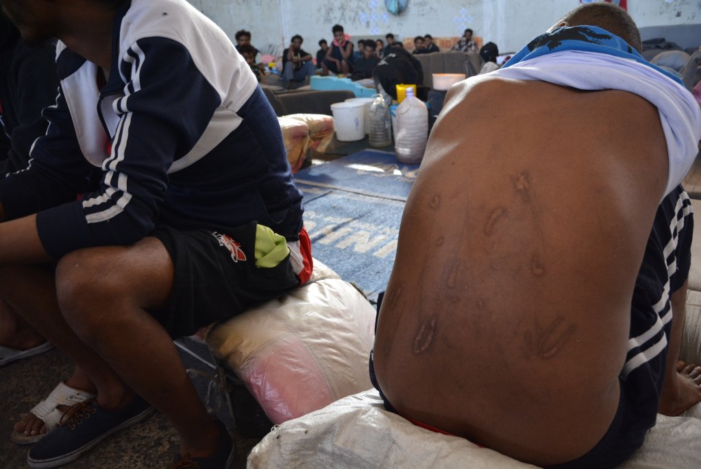 Scars and wounds inflicted during captivity at the hands of traffickers in Libya | Photo: Jérôme Tubiana/MSF