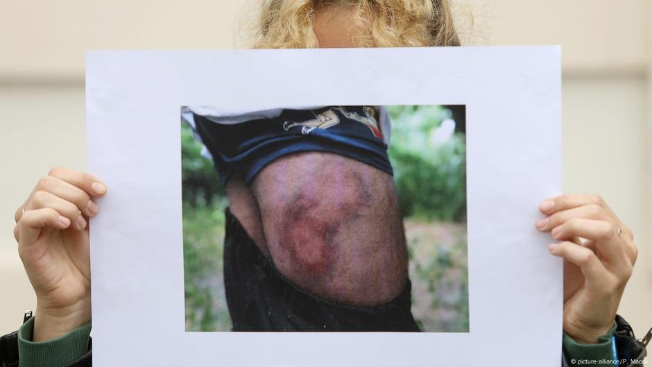 A refugee activist at a press conference in London in October 2018 shows a photo of a migrant with bruising on his legs | Photo: picture-alliance/P. Macek